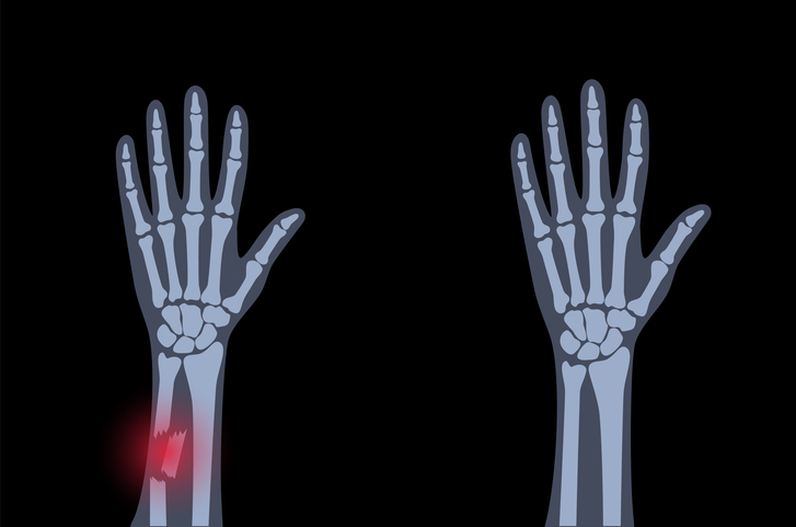 팔목이 골절된 것을 볼 수 있는 엑스레이 화면이다.